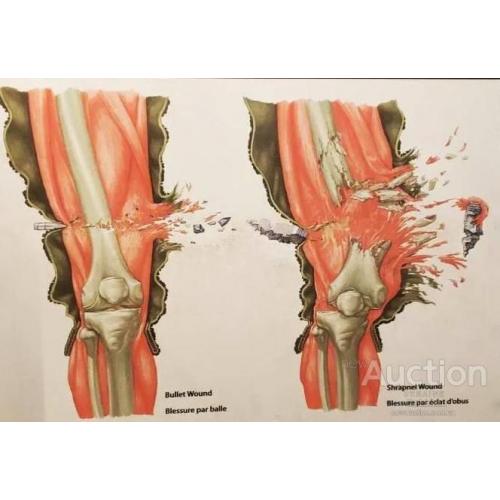 Различия между пулевым и осколочным ранениями.